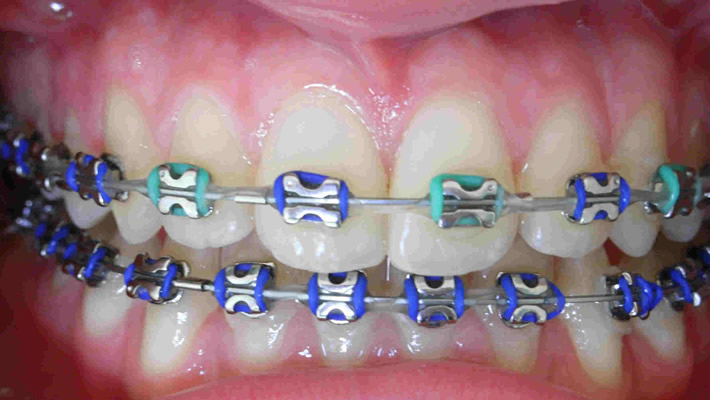 Diş Teli Uygulaması ile Mükemmel Dişlere Kavuşmak ile ilgili görsel sonucu