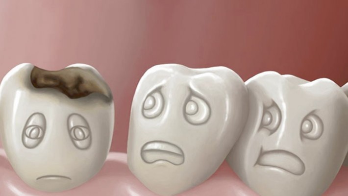 Diş Çürüklerinden Korunma Yöntemleri
