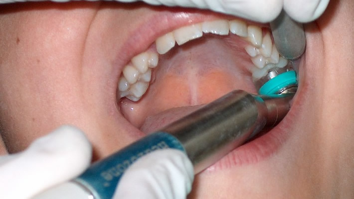 Diş Taşı Temizliği Neden Önemlidir?